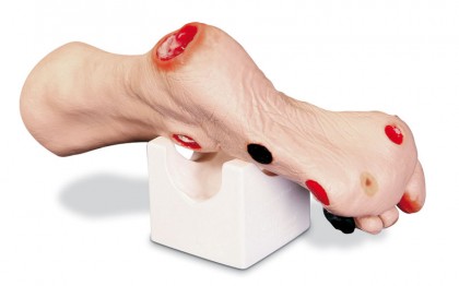Wundset, Wundmoulage „Wilma“ Wundenfu�
