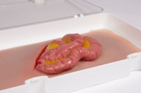 Wundmoulage D�nndarmaustritt