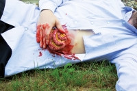 Wundmoulage D�nndarmaustritt
