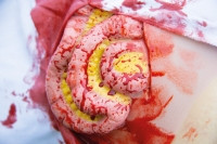 Wundmoulage D�nndarmaustritt