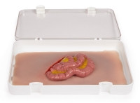 Wundmoulage D�nndarmaustritt