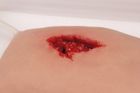"Wundmoulage wound packing"