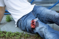 "Wundmoulage wound packing"