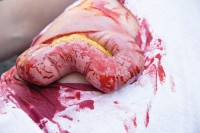 "Wundmoulage Dickdarmaustritt"
