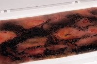 Wundmoulage Verbrennung III. Grades