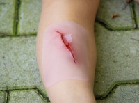"Wundmoulage Schnittwunde mit Glassplitter"