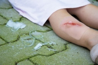 "Wundmoulage Schnittwunde mit Glassplitter"