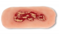 Wundmoulage Ulcus Cruris Venosum, klein, Exsudationsphase