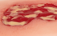 Wundmoulage Ulcus Cruris Venosum, klein, Exsudationsphase