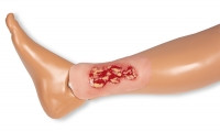 Wundmoulage Ulcus Cruris Venosum, klein, Exsudationsphase