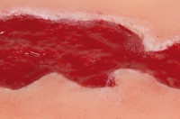 Wundmoulage Ulcus Cruris Venosum, klein, Granulationsphase