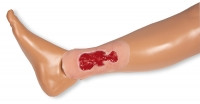Wundmoulage Ulcus Cruris Venosum, klein, Granulationsphase