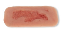 Wundmoulage Ulcus Cruris Venosum, klein, Epithelisierungsphase