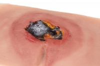 Wundmoulage sakraler Dekubitus, unbehandelt
