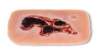 Wundmoulage Ulcus Cruris Arteriosum, klein, Exsudationsphase