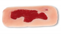 Wundmoulage Ulcus Cruris Arteriosum, klein, Granulationsphase