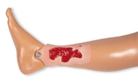 Wundmoulage Ulcus Cruris Arteriosum, klein, Granulationsphase
