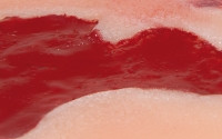 Wundmoulage Ulcus Cruris Arteriosum, klein, Granulationsphase