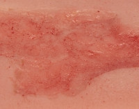 Wundmoulage Ulcus Cruris Arteriosum, klein, Epithelisierungsphase