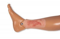 Wundmoulage Ulcus Cruris Arteriosum, klein, Epithelisierungsphase