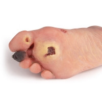 Wundenfu� mit diabetischem Fu�syndrom