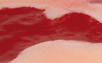 Wundmoulage Ulcus Cruris Arteriosum, klein, Granulationsphase