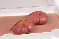 "Wundmoulage Dickdarmaustritt"